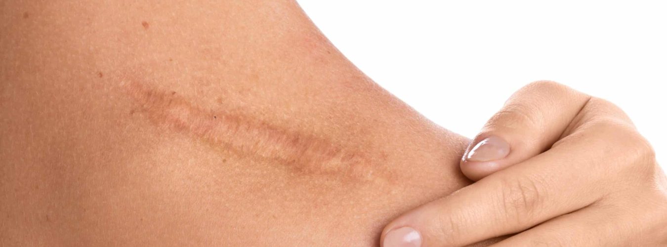 cover-les-differentes-cicatrices-et-leurs-traitements-dr-skin-marceau-scaled