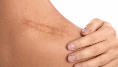 cover-les-differentes-cicatrices-et-leurs-traitements-dr-skin-marceau-scaled