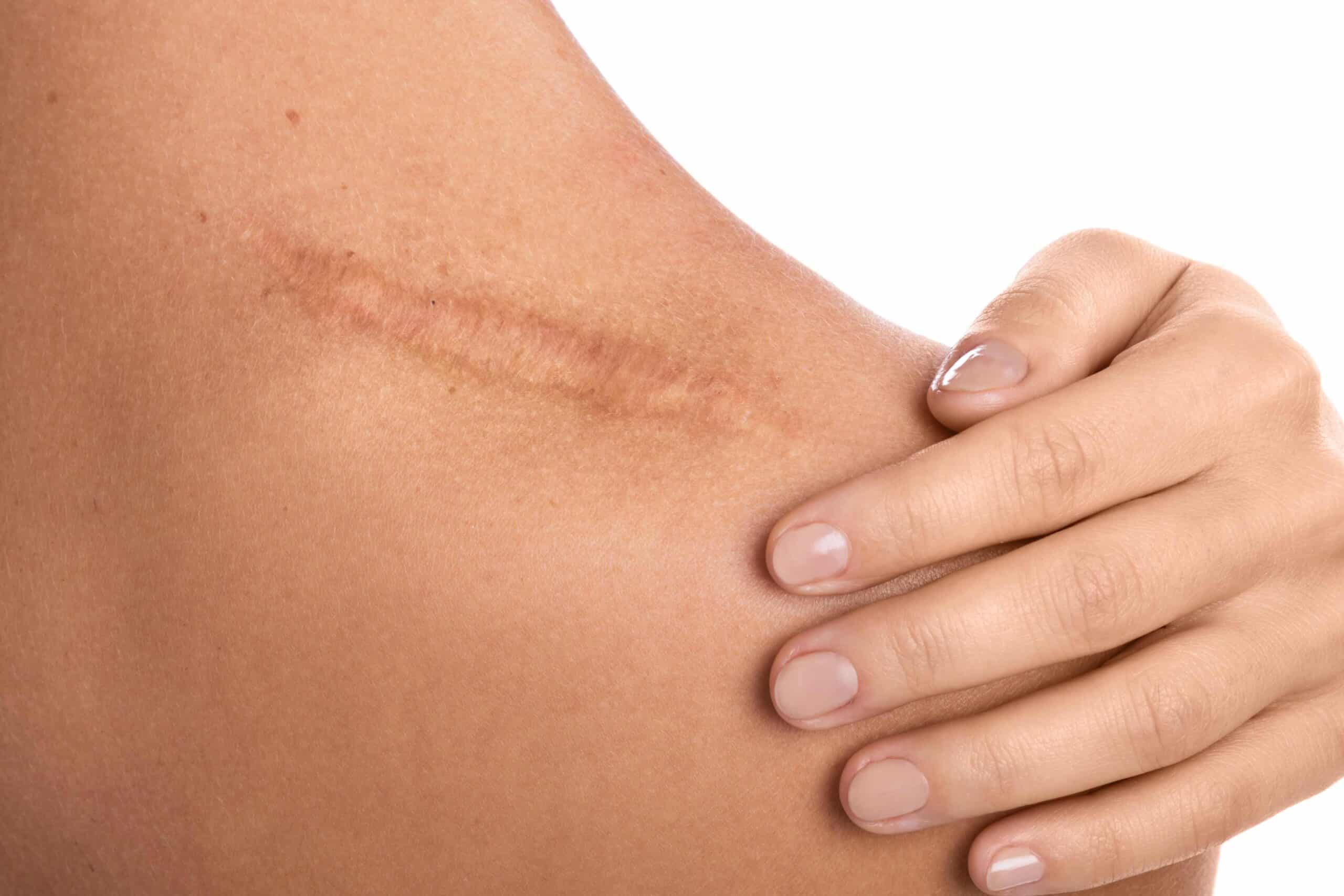 cover-les-differentes-cicatrices-et-leurs-traitements-dr-skin-marceau-scaled